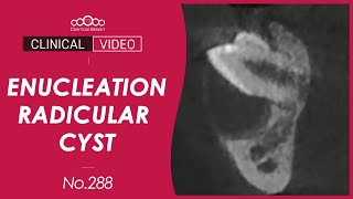 Enucleation of Radicular Cyst Dr Cho Yongseok [upl. by Hosfmann]