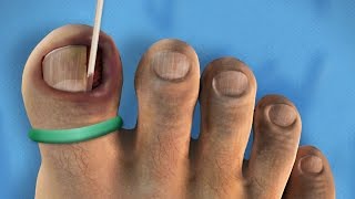 SO DISGUSTING  Ingrown Toenail Surgery [upl. by Intosh]