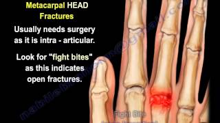 Metacarpal Fractures  Everything You Need To Know  Dr Nabil Ebraheim [upl. by Calli]