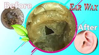 Ear Wax Removal Myths Debunked What You Need to Know 019 [upl. by Bounds]