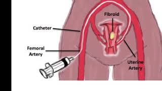 SIRMSC Uterine Fibroid Embolization [upl. by Loss]