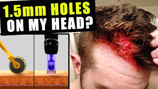 I Cut Thousands Of 15 Millimetre Holes In My Head Every Week To Prevent Hair Loss [upl. by Eenimod518]