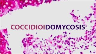 Coccidioidomycosis Valley Fever  Pediatric Grand Grounds  Mattel Childrens Hospital UCLA [upl. by Cherrita]