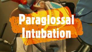 Vie Scope® Paraglossal Intubation OffMolar Intubation [upl. by Eirollam506]