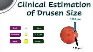 Clinical Estimation of Drusen Size [upl. by Maximilianus]