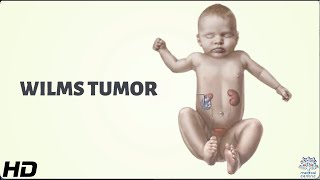 Wilms Tumor Everything You Need To Know [upl. by Bainter219]