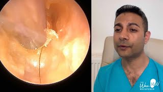 1509  Chronic Bacterial Ear Infection  Eardrum Anatomy and Eustachian Tube Function Explained [upl. by Schatz]