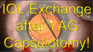 IOL exchange surgery with open capsule after YAG capsulotomy  Dr Simon Chen [upl. by Kelci]