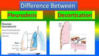 Difference between Pleurodesis and Decortication [upl. by Farrison110]