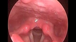 Video laryngoscopy of chronic allergic rhinosinusitis with PND  GERD amp tonsil stone [upl. by Arua]