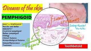 Pemphigoid Causes pathogenesis Types Histopathology Treatment  Pemphigus vs Pemphigoid [upl. by Ainocal]