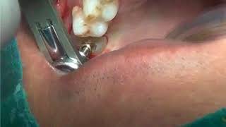 Gingivectomy for emergence profile with diamond bur [upl. by Furgeson53]