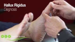 Hallux Rigidus Causes Diagnosis and Treatment [upl. by Dee750]