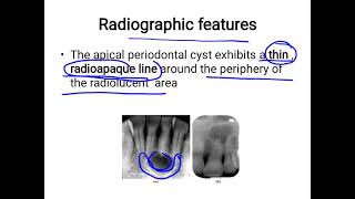 Radicular cyst [upl. by Dibb]