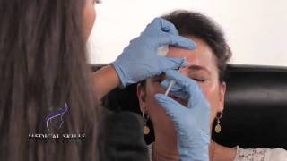 Botulinum Toxin  Injection Technique [upl. by Circosta335]