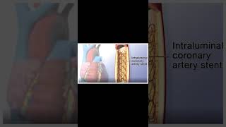 Angioplasty Procedure Animation VideoWhat are the steps of angioplasty [upl. by Adihsaar938]