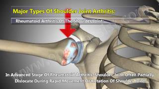 5 Major Types of Shoulder Arthritis Osteoarthritis Rheumatoid Septic Gout Pseudogout [upl. by Yleek]