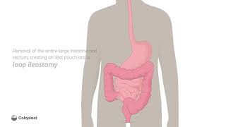 Creation of loop ileostomy by removing large intestine rectum  Ostomy surgery  Coloplast India [upl. by Sofko]