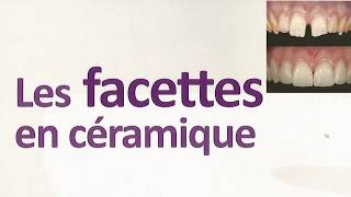 Les Facettes Dentaire [upl. by Baryram]