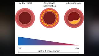 Atherosclerosis [upl. by Eissed]