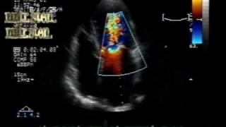 MS different aspectsmitral stenosis with leaflets borders calcification [upl. by Erminia831]