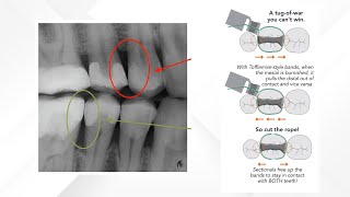 Sectional Matrix System versus TofflemireStyle System [upl. by Lauren]