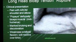 Long Head Biceps Tendon Rupture [upl. by Eelesor]