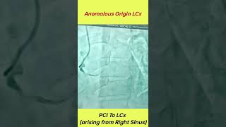 Anomalous Origin Left Circumflex Artery Arising From Right Sinus anomalous coronary artery origins [upl. by Alyl]