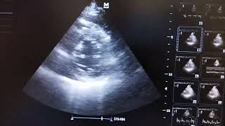 Global hypokinesia of left ventricle in PSAX echo view at mid ventricular level [upl. by Dermot]