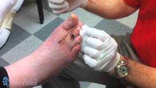 Dr Matthew Neuhaus Removes Wire From Toe After Hammertoe Surgery [upl. by Weiler]