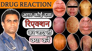 Adverse Drug Reaction  अगर कोई दवा Reaction कर जाए तो क्या करे  Drug Reaction Treatment [upl. by Llertnov]