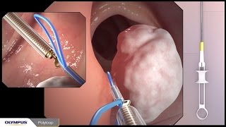 Colonoscopy with polypectomy procedure overview using Olympus devices [upl. by Sreip647]