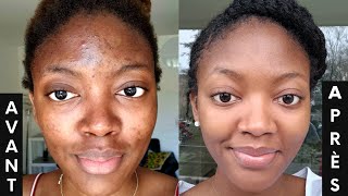 L ACNÉ COMMENT s en DÉBARRASSER 3 PRODUITS contre les boutons et les tâches🔥  SKINCARE ROUTINE💦 [upl. by Neehs]