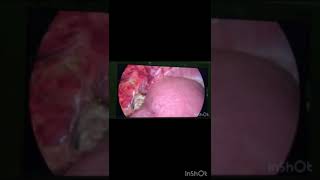 Laproscopic hydatid cyst liver surgery [upl. by Palocz271]