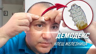 Мелкий паразит живет в коже каждого человека  Угревая Железница Demodex [upl. by Phillie]