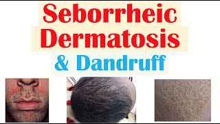 Seborrheic Dermatitis Dandruff and Cradle Cap Causes Risk Factors Symptoms Diagnosis Treatment [upl. by Morra]