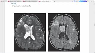 NEURORADIOLOGY EXAM CASES LECTURE [upl. by Jacenta]