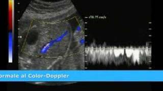 MED2000ECO Persistenza della Vena Ombelicale Destra [upl. by Wendin]