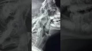 Adenoid and Tonsillar hypertrophy on lateral neck X ray [upl. by Kcirdderf626]