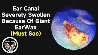 Ear Canal Severely Swollen Because Of Giant EarWax  巨大な耳垢のせいで外耳道がひどく腫れている [upl. by Estelle515]