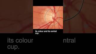 Examining the fundus – part 2 ophthalmology [upl. by Neirda422]