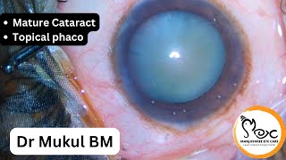 Mature cataract  Topical phaco [upl. by Ivah]