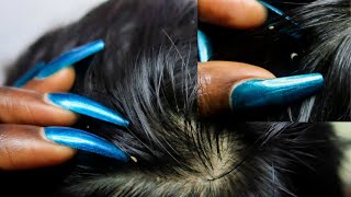 ASMR Allzoomed Full Head Scalp Nitpicking Whiteheads 1HR 🤯 [upl. by Ytsud]