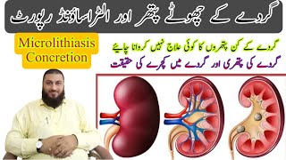 Microlithiasis  concretion  Renal Calculus  Kidney stones  Treatment [upl. by Annahsat131]