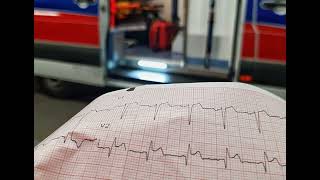 Episode 53 Evaluation and Management of STSegment Elevation Myocardial Infarction in the Emerge [upl. by Nyrok]