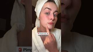 🚨 Pimple hack 🚨 skincare skincarehack skincaretips [upl. by Lacee]