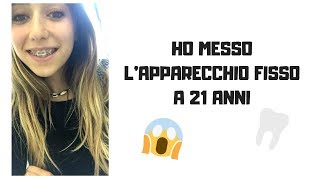 HO MESSO LAPPARECCHIO FISSO A 21 ANNI [upl. by Nylanna]