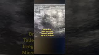 Breast mass breast cancer ultrasound findings [upl. by Magda755]