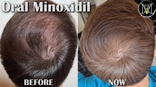 Oral Minoxidil Loniten Results in 10 Months [upl. by Nina]