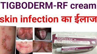 Tigoderm rf creambeclomethasone dipropionate econazole neomycin cream uses benifits in hindizolef [upl. by Sirdna]